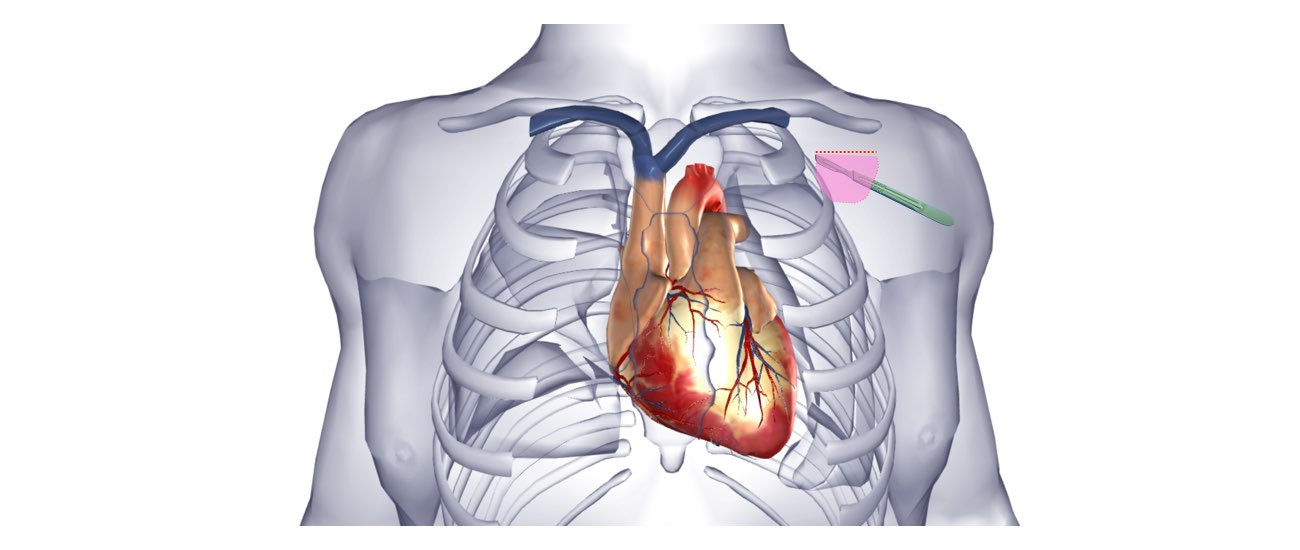 The image illustrates the Defibrillator Implantation procedure.