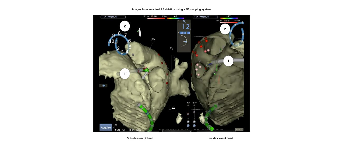 Images from an actual AF ablation using a 3D mapping system.