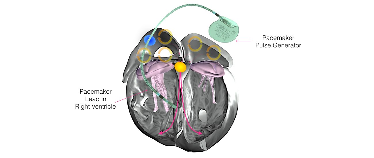 The image shows the implantation of a pacemaker and it's lead in the right ventricle.